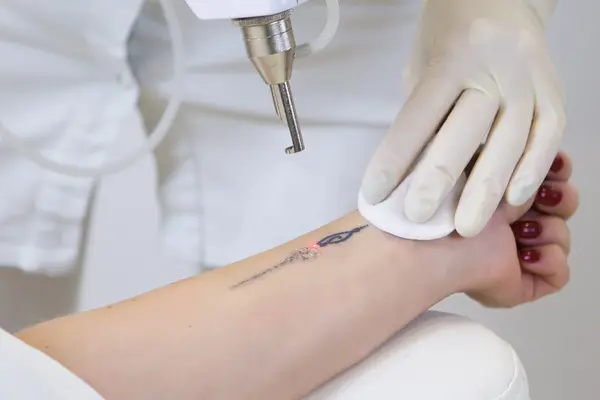 Remoción de Tatuaje